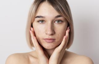 Дерматологи: питание, гормоны и стресс влияют на развитие акне