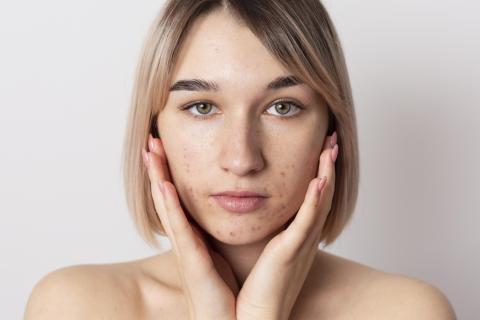 Дерматологи: питание, гормоны и стресс влияют на развитие акне