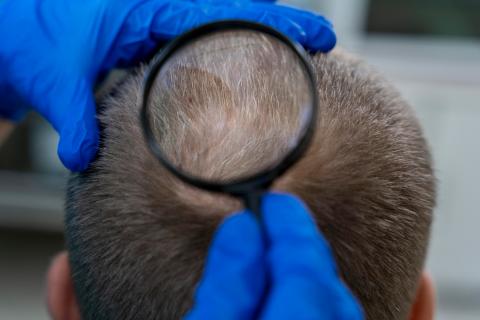 Учёные выяснили, что миноксидил в сочетании со стевией эффективнее стимулирует рост волос