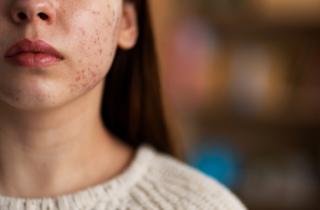 Некоторые лазерные процедуры усугубляют купероз — дерматолог Сафонова