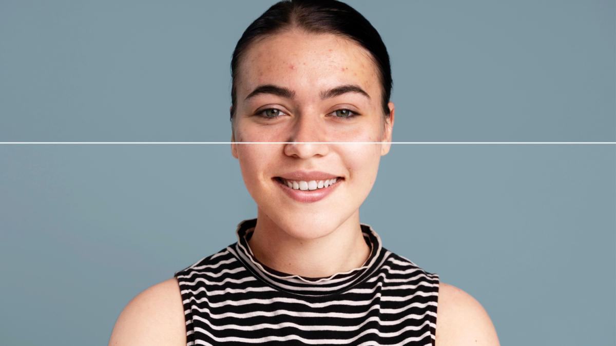 Маскировка прыщей макияжем