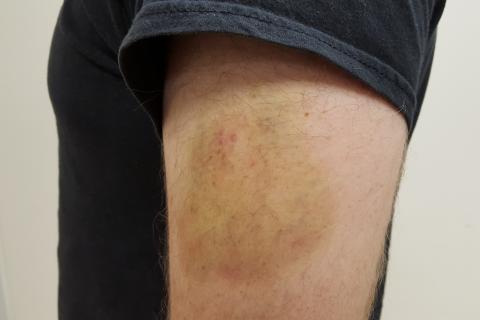 Дефицит витамина C делает сосуды более хрупкими — SELF