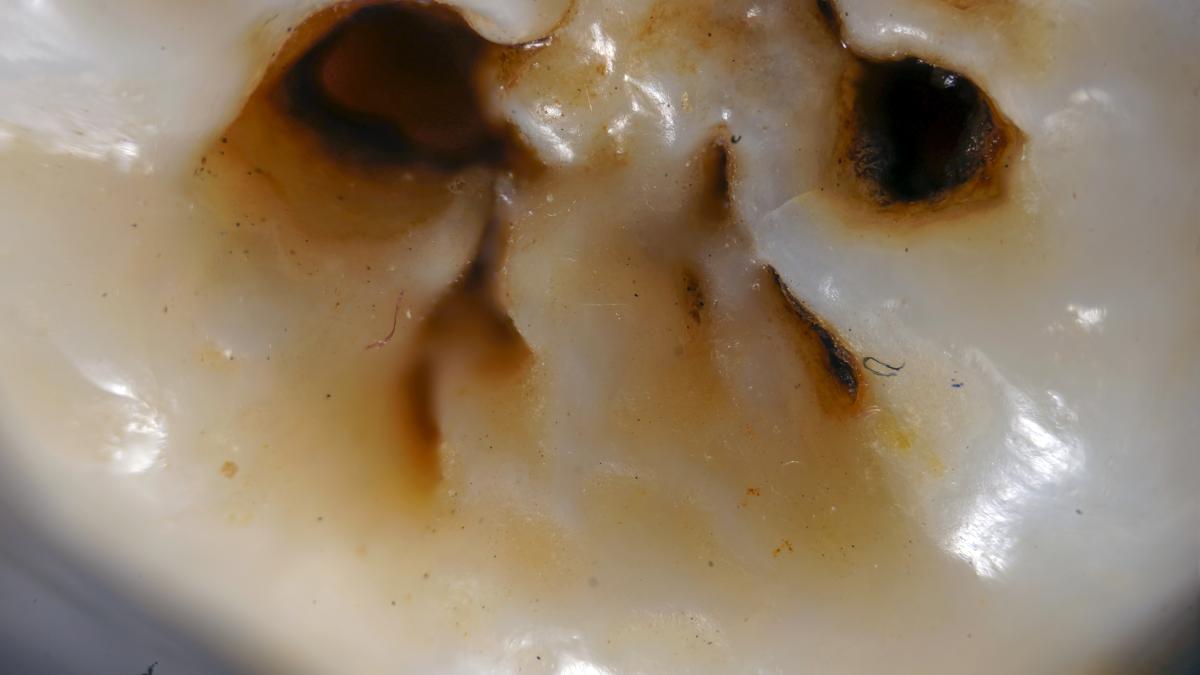 Кариес зуба мудрости